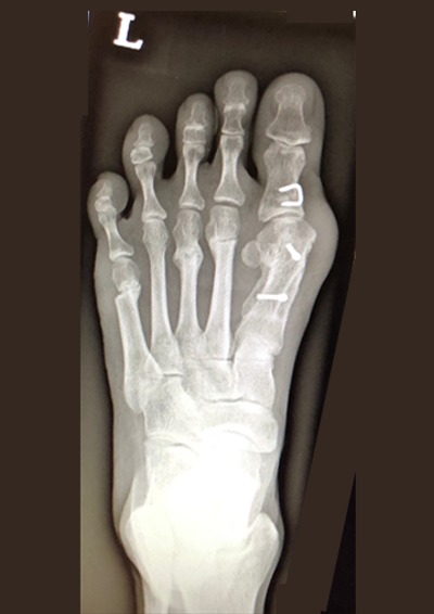 图片2. X光检查显示常规手术矫正。