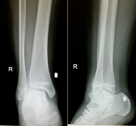 图25：损伤后X光片显示三平面骨折。