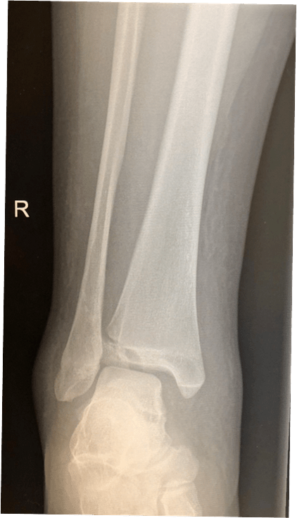 图29：损伤后X光片显示腓骨轻微骨折和胫骨Tillaux骨折。