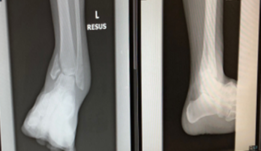 Figure-4.-ankle-fractures