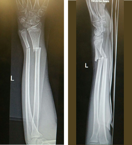 图7：X光片显示骨折。
