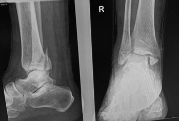 图7：X光照片，显示在其他地方治疗过的延误就诊的骨折。