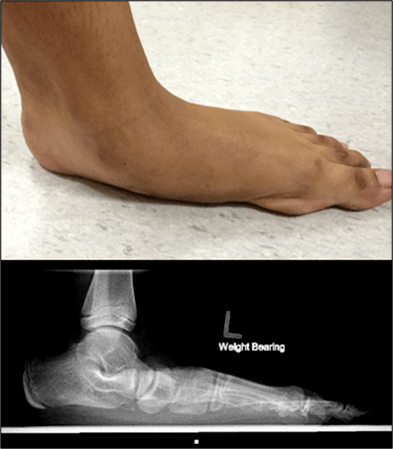 图8：照片和X光照片显示疼痛性柔性扁平足
