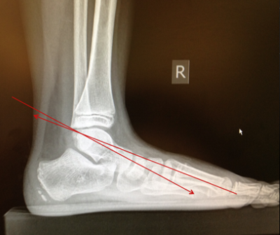 图2：足部侧位X光照片显示Meary角和纵弓下降。