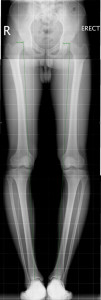Knee osteotomy