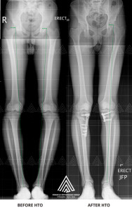 Knee osteotomy surgery