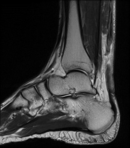 MRI of Achilles tendon tear