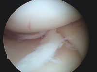 Sobekan Meniscus