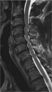 Spinal Stenosis