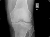Osteotomi Lutut