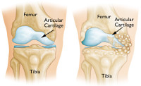 Knee osteotomy