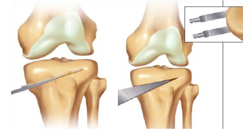 Knee osteotomy procedure