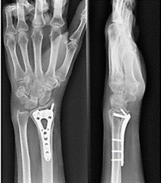 手术后愈合良好的腕关节骨折的X光检查