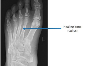 X-ray showing a healed foot stress fracture