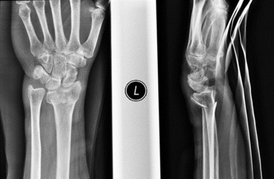 Pre-op X-rays of a wrist fracture