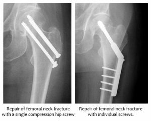 Repair of Femoral Neck Hip Fracture