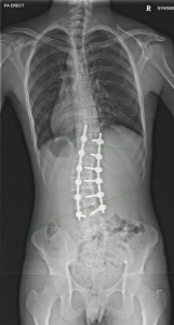 scoliosis surgery