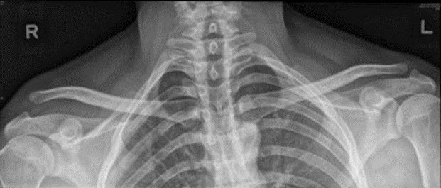 肩锁关节脱位 手术 - 新加坡骨科专家