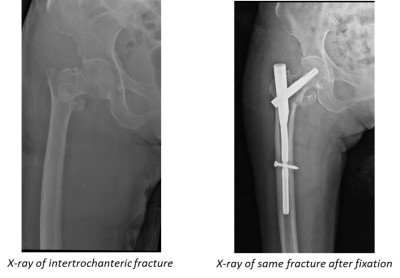 X-ray of intertrochanteric fracture before and after fixation