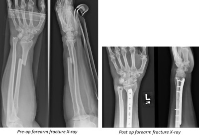 X-rays forearm fracture