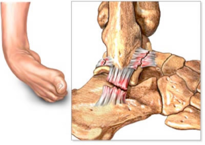 ankle joint tear
