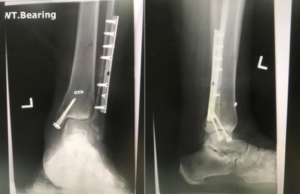 Figure 3. ankle fractures