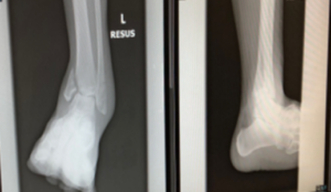 Figure 4. ankle fractures