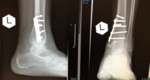 Figure 6. ankle fractures