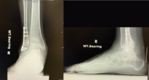 Figure 9. ankle fractures