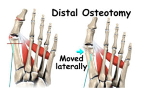 osteotomy foot surgery