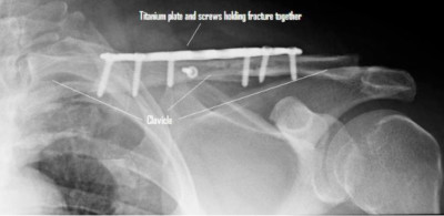 clavicle fracture plates and screws