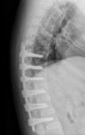 Ankylosing Spondylitis