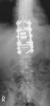 Spinal Tumor