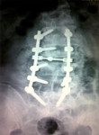 Scoliosis treatment Fusion