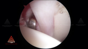 Arthroscopic view inside a hip joint with special instruments used to gain access into the joint
