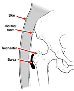 hip bursitis 