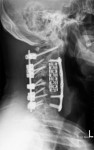 Crooked Spine Treatment