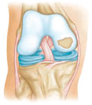 cartilage repair