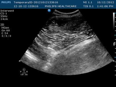 PRP Treatment Ultrasound