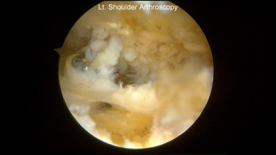 Shoulder arthroscopy inflamed bursa